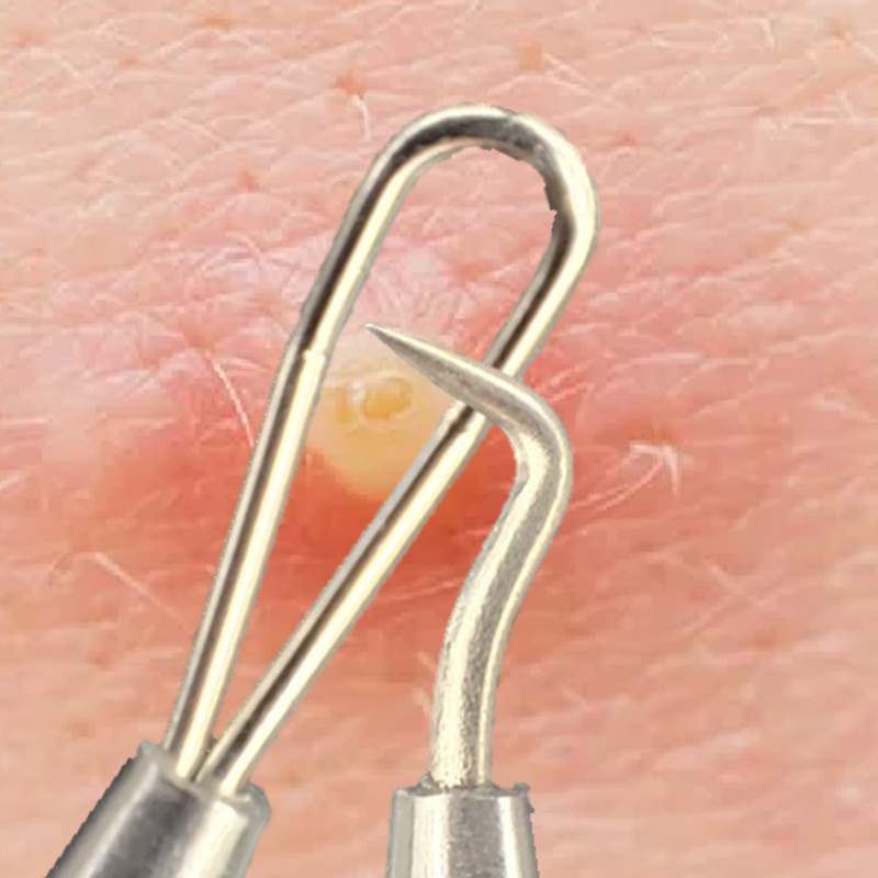 집에서 간편하게 여드름 제거하는 방법과 추천 도구